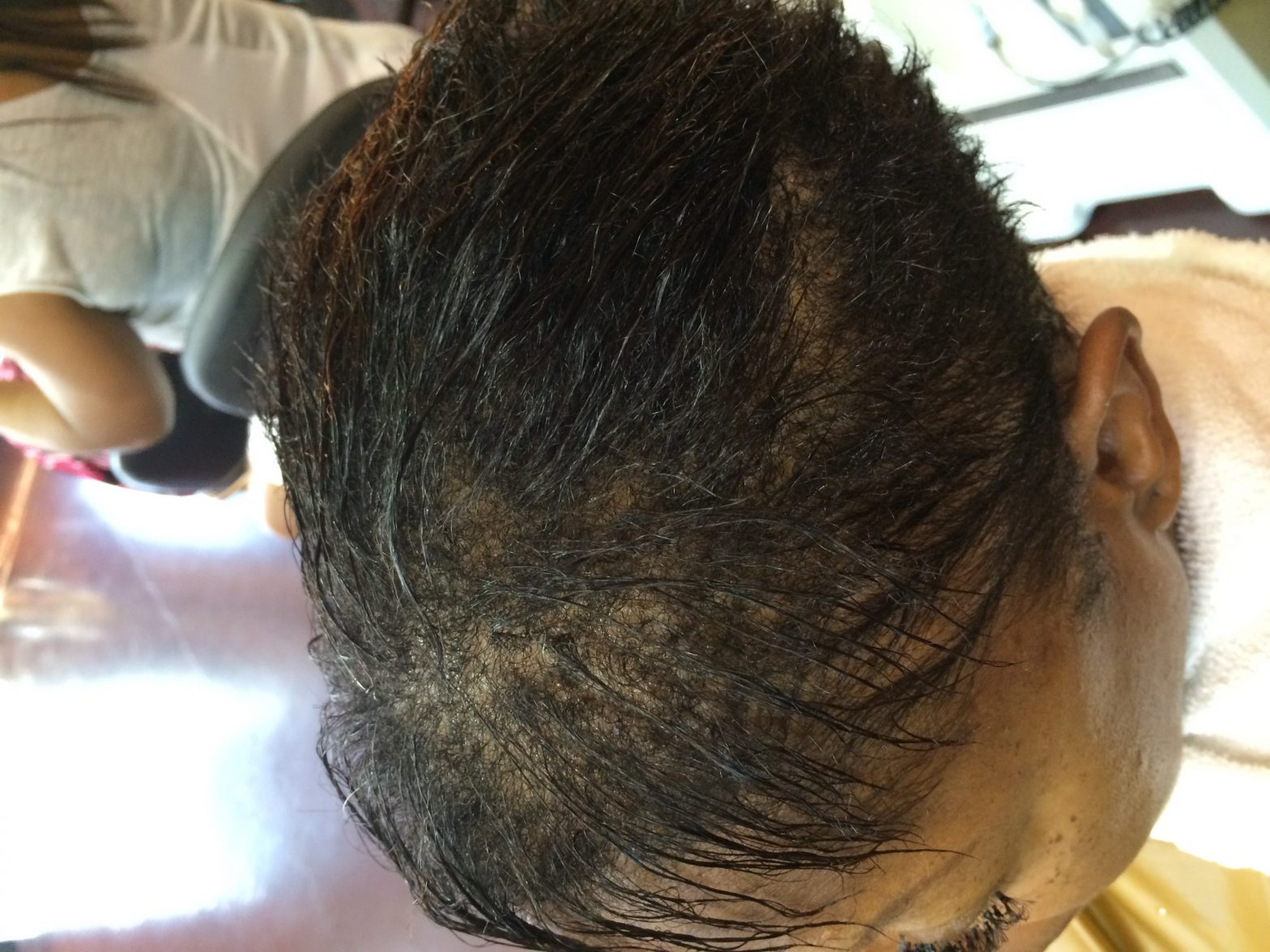 Tinea capitis – Manewellness Hair Loss Center